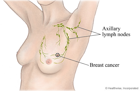 Breast Cancer Treatment My Doctor Online